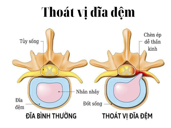 Thoát vị đĩa đệm